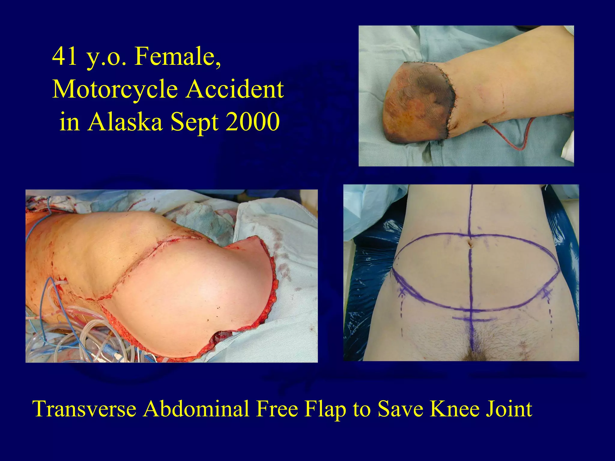 Transverse Abdominal Free Flap to Save Knee Joint
41 y.o. Female,
Motorcycle Accident
in Alaska Sept 2000
 