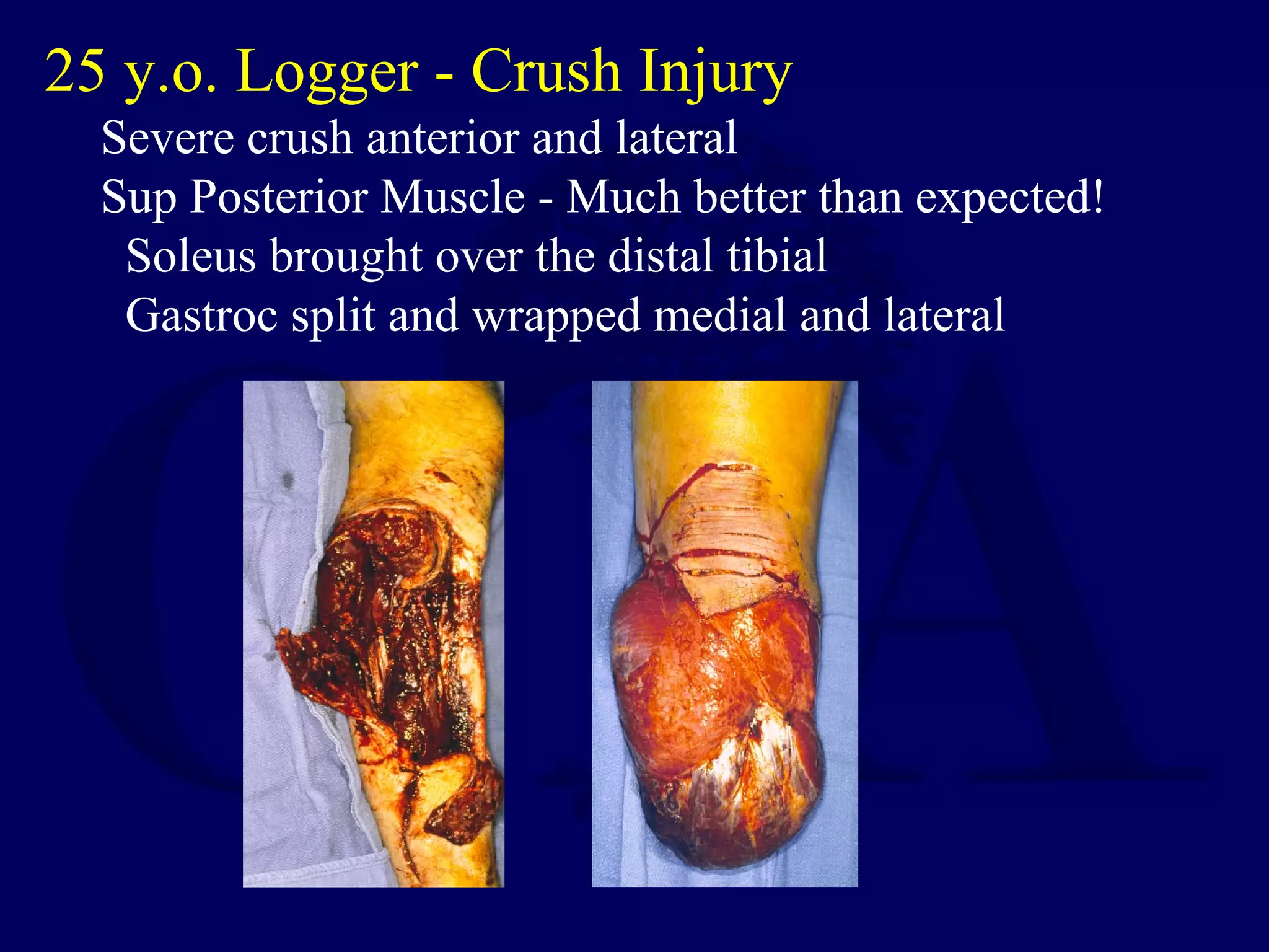 25 y.o. Logger - Crush Injury
Severe crush anterior and lateral
Sup Posterior Muscle - Much better than expected!
Soleus brought over the distal tibial
Gastroc split and wrapped medial and lateral
 