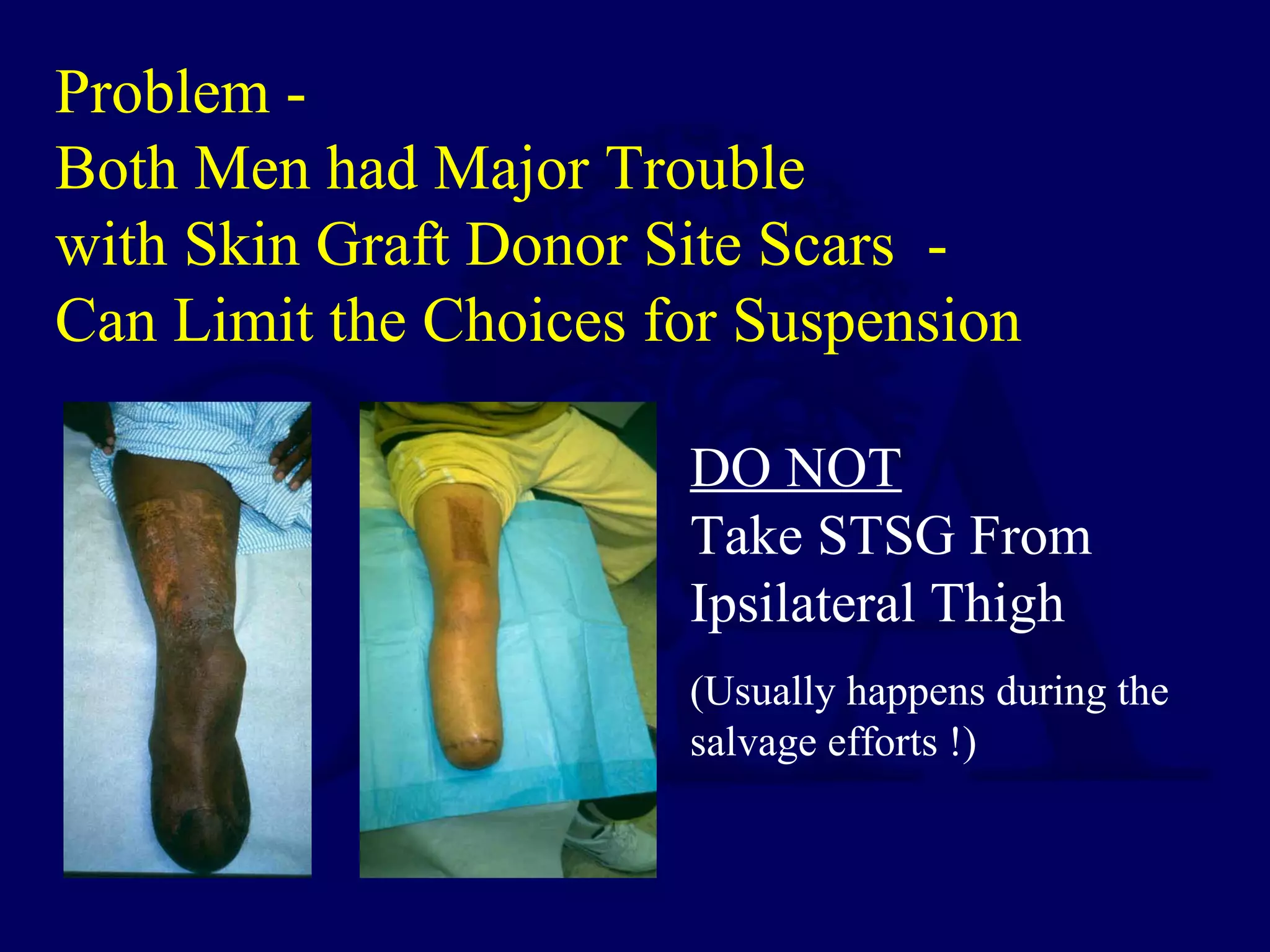 Problem -
Both Men had Major Trouble
with Skin Graft Donor Site Scars -
Can Limit the Choices for Suspension
DO NOT
Take STSG From
Ipsilateral Thigh
(Usually happens during the
salvage efforts !)
 