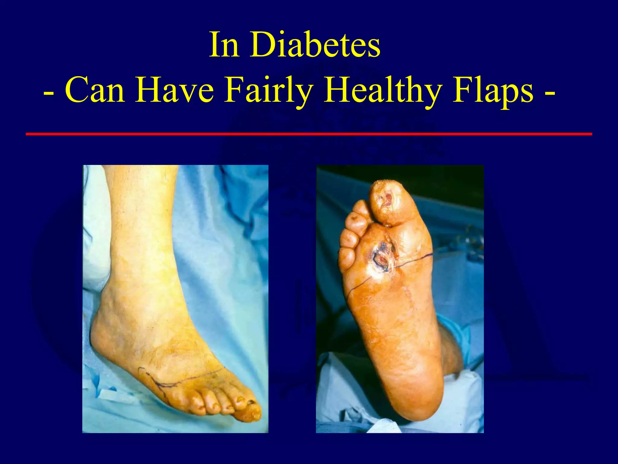 In Diabetes
- Can Have Fairly Healthy Flaps -
 