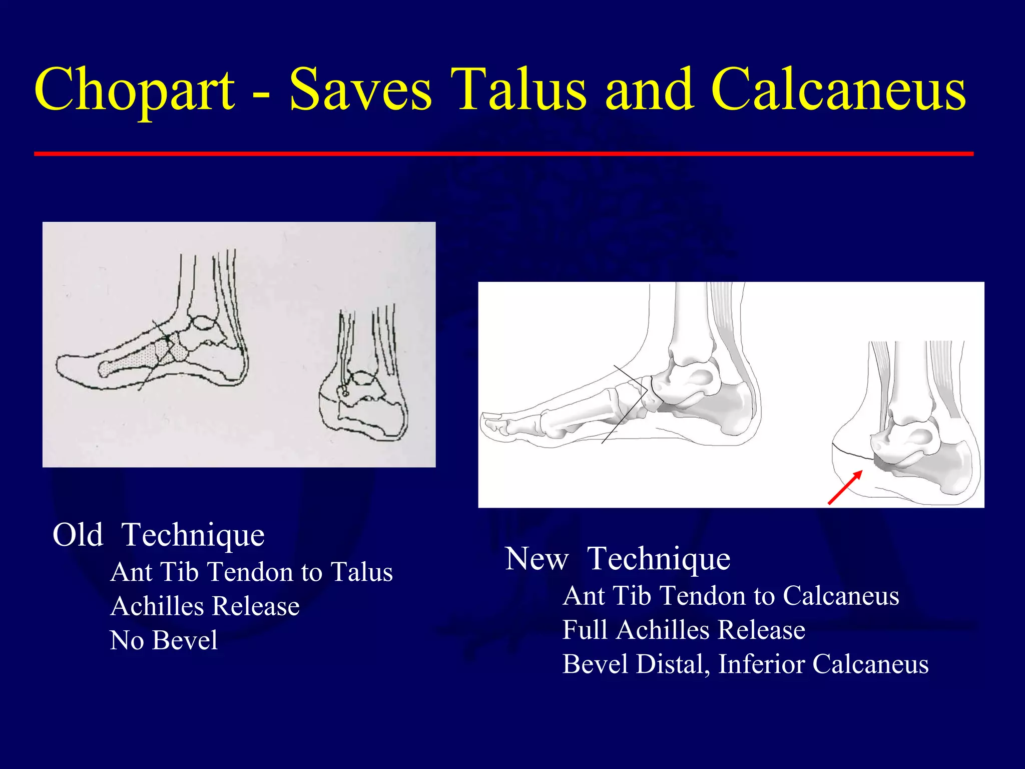 Chopart - Saves Talus and Calcaneus
Old Technique
Ant Tib Tendon to Talus
Achilles Release
No Bevel
New Technique
Ant Tib Tendon to Calcaneus
Full Achilles Release
Bevel Distal, Inferior Calcaneus
 