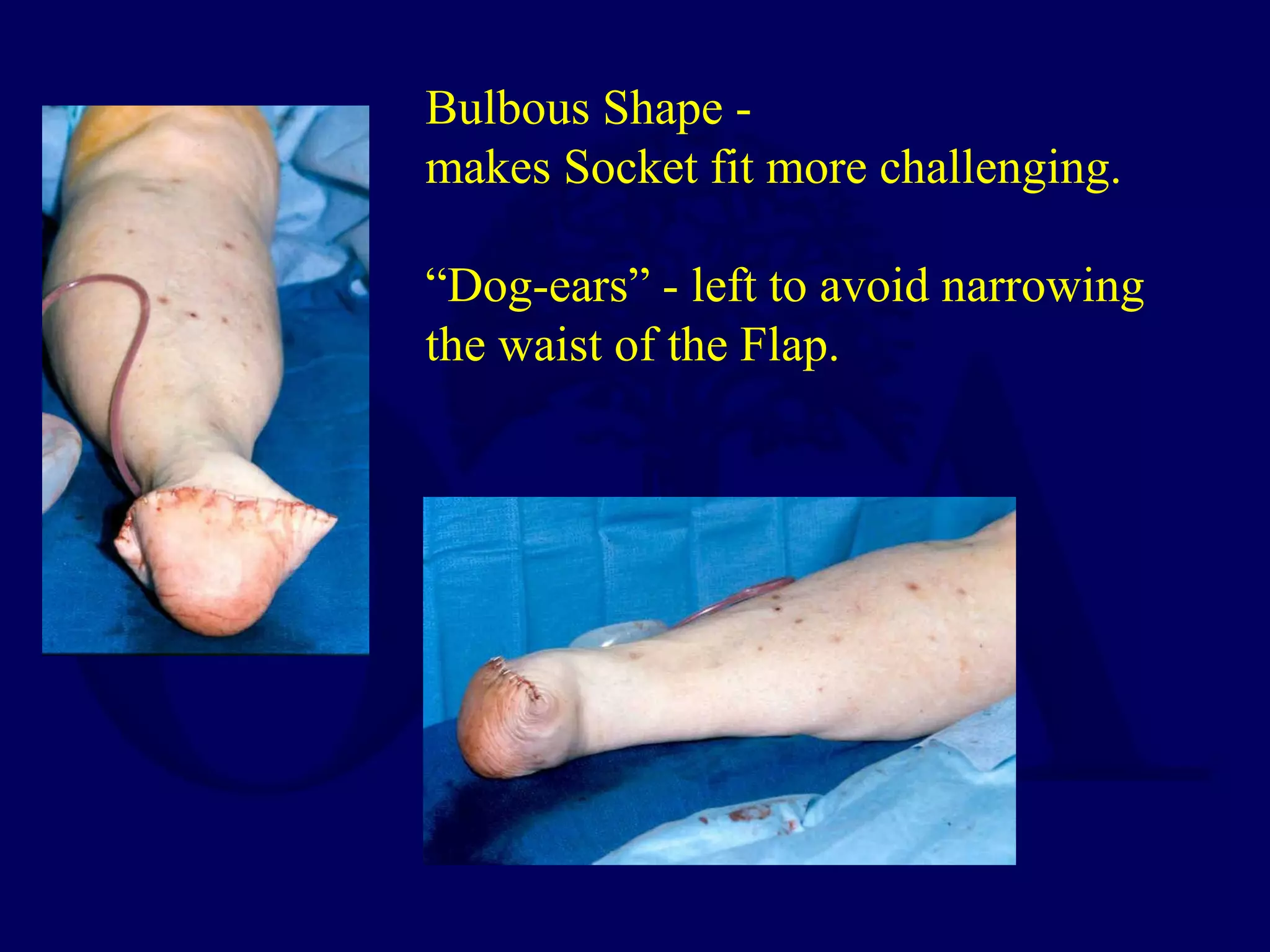 Bulbous Shape -
makes Socket fit more challenging.
“Dog-ears” - left to avoid narrowing
the waist of the Flap.
 