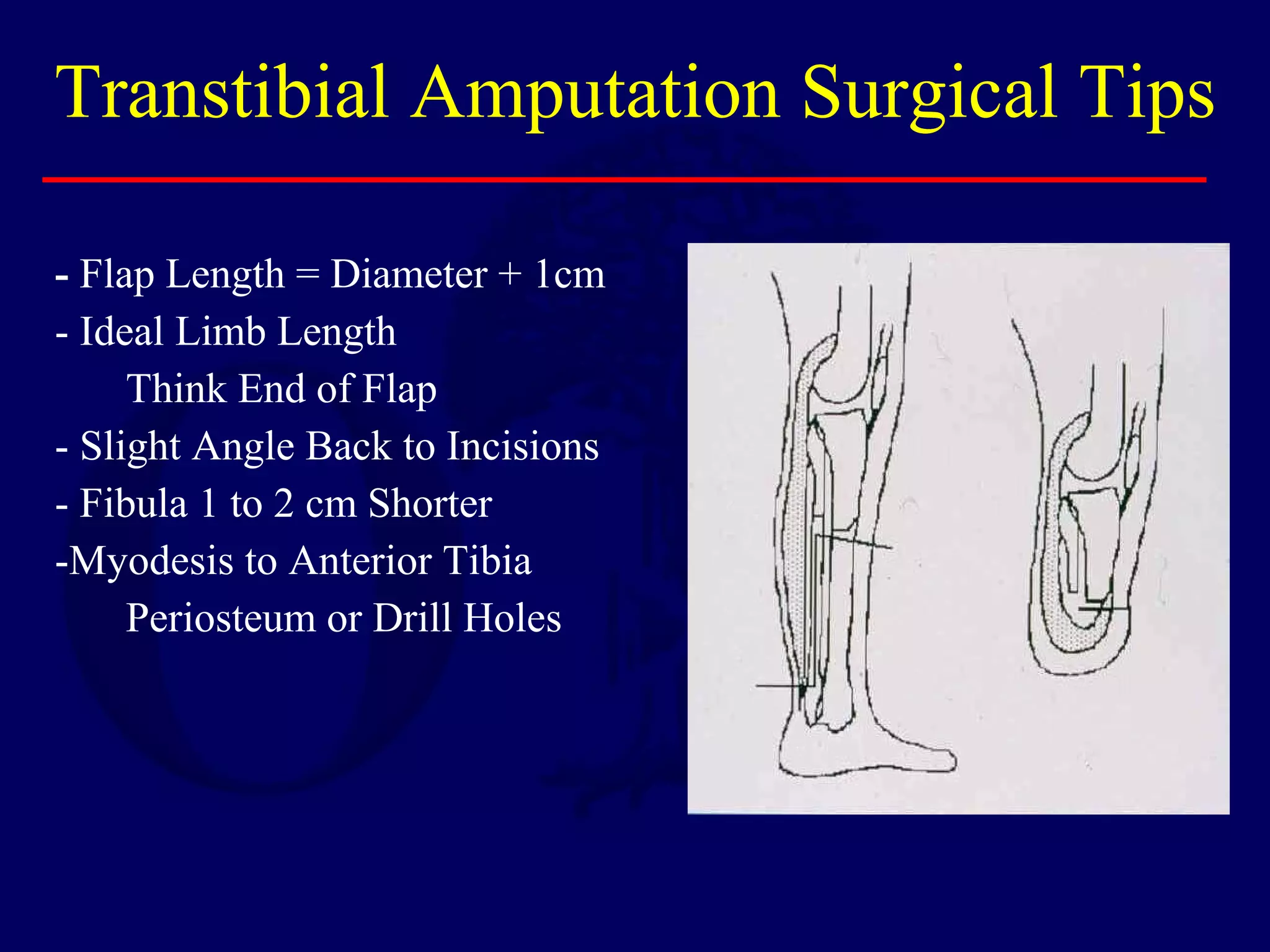 - Flap Length = Diameter + 1cm
- Ideal Limb Length
Think End of Flap
- Slight Angle Back to Incisions
- Fibula 1 to 2 cm Shorter
-Myodesis to Anterior Tibia
Periosteum or Drill Holes
Transtibial Amputation Surgical Tips
 