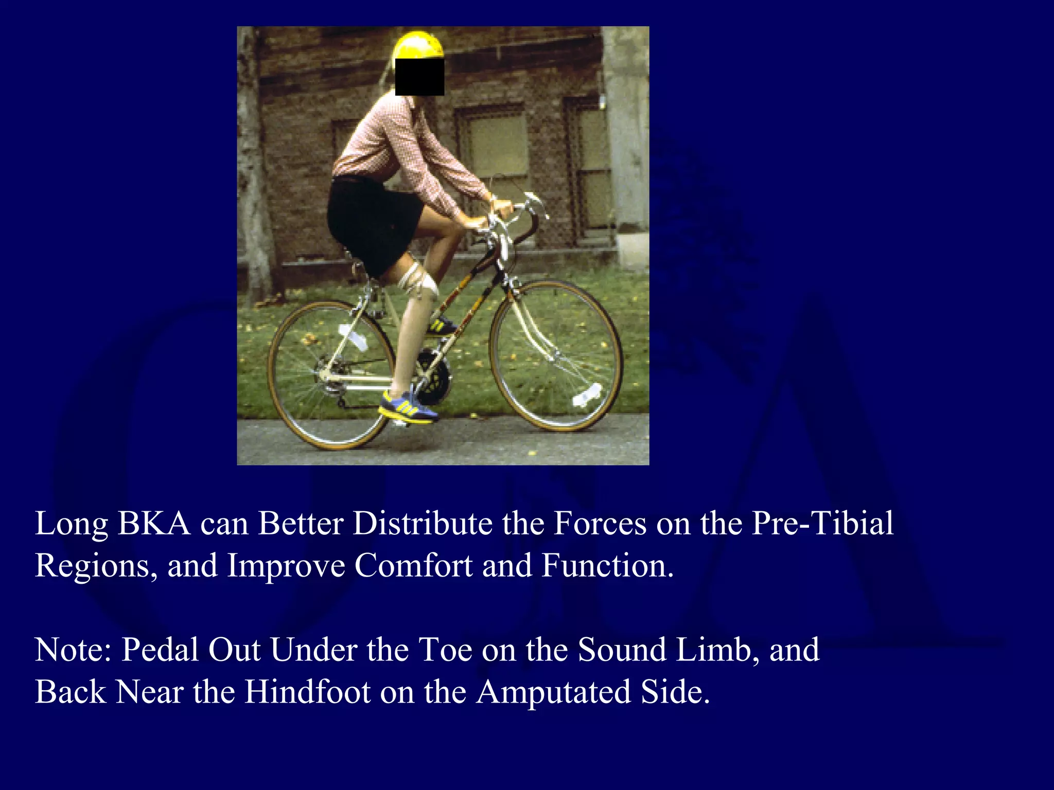 Long BKA can Better Distribute the Forces on the Pre-Tibial
Regions, and Improve Comfort and Function.
Note: Pedal Out Under the Toe on the Sound Limb, and
Back Near the Hindfoot on the Amputated Side.
 