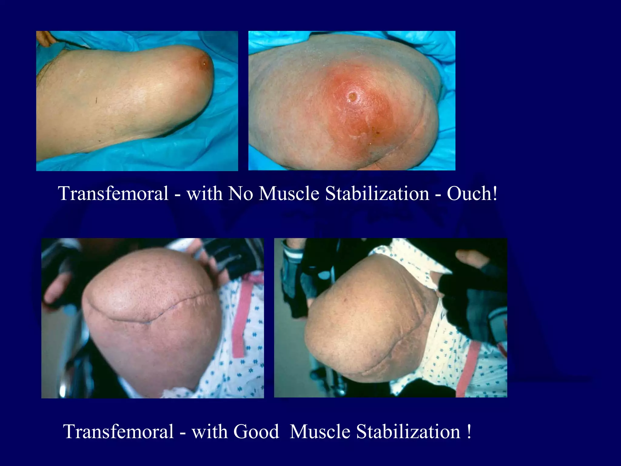Transfemoral - with No Muscle Stabilization - Ouch!
Transfemoral - with Good Muscle Stabilization !
 