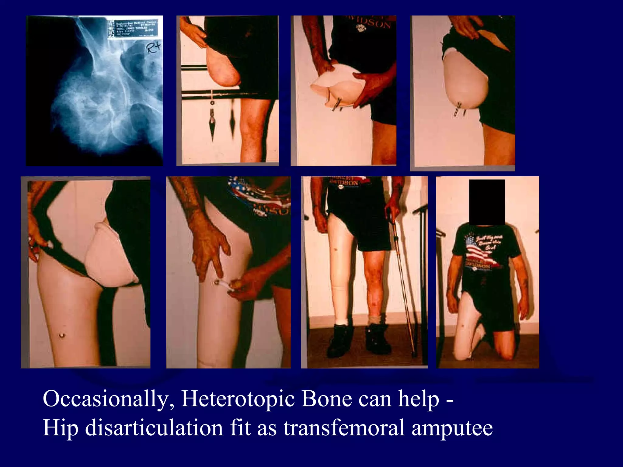 Occasionally, Heterotopic Bone can help -
Hip disarticulation fit as transfemoral amputee
 