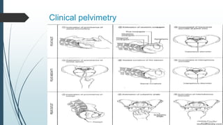 Clinical pelvimetry
 