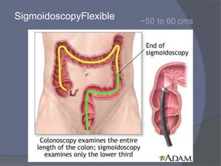 Flexible
Sigmoidoscopy ~50 to 60 cms
 