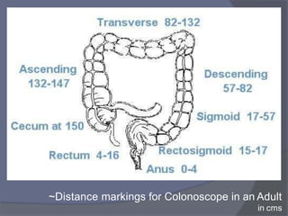 ~Distance markings for Colonoscope in an Adult
in cms
 