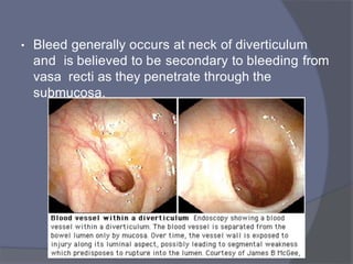 • Bleed generally occurs at neck of diverticulum
and is believed to be secondary to bleeding from
vasa recti as they penetrate through the
submucosa.
 