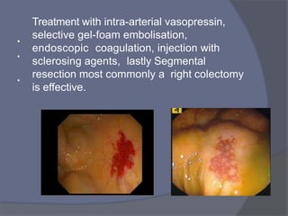 •
Treatment with intra-arterial vasopressin,
selective gel-foam embolisation,
endoscopic coagulation, injection with
sclerosing agents, lastly Segmental
resection most commonly a right colectomy
is effective.
•
•
 