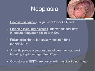 Neoplasia
• Uncommon cause of significant lower GI bleed
• Bleeding is usually painless, intermittent and slow
in nature, frequently assoc with IDA
• Polyps also bleed, but usually occurs after a
polypectomy
• Juvenile polyps are second most common cause of
bleeding in pts younger than 20yrs
• Occasionally, GIST’s are assoc with massive hemorrhage
 