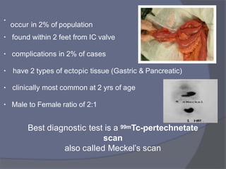 •
occur in 2% of population
• found within 2 feet from IC valve
• complications in 2% of cases
• have 2 types of ectopic tissue (Gastric & Pancreatic)
• clinically most common at 2 yrs of age
• Male to Female ratio of 2:1
Best diagnostic test is a 99mTc-pertechnetate
scan
also called Meckel’s scan
 