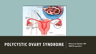 POLYCYSTIC OVARY SYNDROME Mahmoud Aljubeh, MD
OBGYN specialist
 