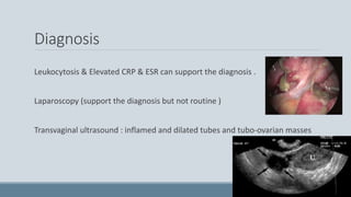 Diagnosis
Leukocytosis & Elevated CRP & ESR can support the diagnosis .
Laparoscopy (support the diagnosis but not routine )
Transvaginal ultrasound : inflamed and dilated tubes and tubo-ovarian masses
 
