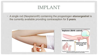 IMPLANT
• A single rod (Nexplanon®) containing the progestogen etonorgestrel is
the currently available providing contraception for 3 years.
 