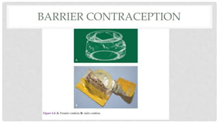BARRIER CONTRACEPTION
 