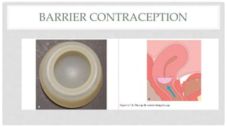BARRIER CONTRACEPTION
 