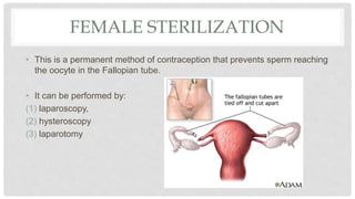 FEMALE STERILIZATION
• This is a permanent method of contraception that prevents sperm reaching
the oocyte in the Fallopian tube.
• It can be performed by:
(1) laparoscopy,
(2) hysteroscopy
(3) laparotomy
 