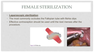 FEMALE STERILIZATION
• Laparoscopic sterilization
• The most commonly occludes the Fallopian tube with filshie clips
• Effective contraception should be used until the next menses after the
procedure.
 