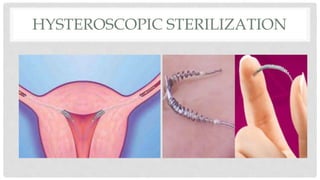 HYSTEROSCOPIC STERILIZATION
 