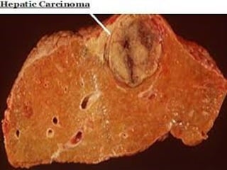HCC
 