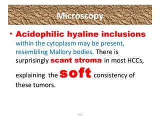 Microscopy
• Acidophilic hyaline inclusions
within the cytoplasm may be present,
resembling Mallory bodies. There is
surprisingly scant stroma in most HCCs,
explaining the soft consistency of
these tumors.
HCC
 