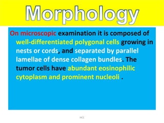 On microscopic examination it is composed of
well-differentiated polygonal cells growing in
nests or cords, and separated by parallel
lamellae of dense collagen bundles. The
tumor cells have abundant eosinophilic
cytoplasm and prominent nucleoli .
HCC
 