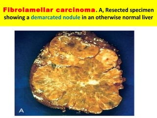 Fibrolamellar carcinoma. A, Resected specimen
showing a demarcated nodule in an otherwise normal liver
HCC
 
