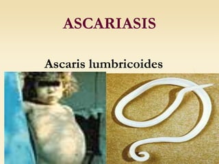 ASCARIASIS
Ascaris lumbricoides
 