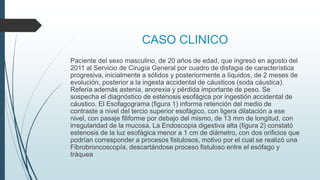 CASO CLINICO
Paciente del sexo masculino, de 20 años de edad, que ingresó en agosto del
2011 al Servicio de Cirugía General por cuadro de disfagia de característica
progresiva, inicialmente a sólidos y posteriormente a líquidos, de 2 meses de
evolución, posterior a la ingesta accidental de cáusticos (soda cáustica).
Refería además astenia, anorexia y pérdida importante de peso. Se
sospecha el diagnóstico de estenosis esofágica por ingestión accidental de
cáustico. El Esofagograma (figura 1) informa retención del medio de
contraste a nivel del tercio superior esofágico, con ligera dilatación a ese
nivel, con pasaje filiforme por debajo del mismo, de 13 mm de longitud, con
irregularidad de la mucosa. La Endoscopia digestiva alta (figura 2) constató
estenosis de la luz esofágica menor a 1 cm de diámetro, con dos orificios que
podrían corresponder a procesos fistulosos, motivo por el cual se realizó una
Fibrobroncoscopía, descartándose proceso fistuloso entre el esófago y
tráquea
 