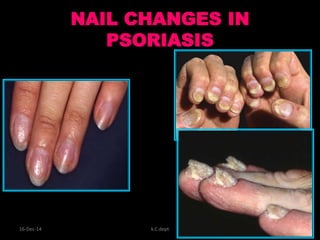 NAIL CHANGES IN
PSORIASIS
16-Dec-14 k.C dept 21
 
