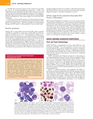 Part VII  Hematologic Malignancies1248
Figure 82-3  EXAMPLES OF KSHV- AND HTLV-1-ASSOCIATED LYMPHOPROLIFERATIVE DISEASE.
Primary effusion lymphoma (A and B). A, The pleural tap had a high cell count, and the cytospin preparation revealed
a markedly pleomorphic cell population with large and giant cells with deep-blue cytoplasm. B, A cell block was pre-
pared (top) so that in situ hybridization studies could be performed. These studies showed the cells to be KSHV+ by
immunohistochemistry for latency associated nuclear antigen-1 (LANA-1) (bottom) and EBV+ by EBER in situ hybrid-
ization (not shown). C, Adult T-cell leukemia/lymphoma in a patient who was HTLV-1+. The peripheral smear showed
the classic “flower” cells. EBER, Epstein-Barr–encoded RNA; HTLV-1, human T-lymphotropic virus-1; KSHV, Kaposi
sarcoma–associated herpesvirus. (A and B courtesy Dr. Elizabeth Hyjek, University of Chicago.)
A B C
Epstein-Barr Virus-Associated Positive Posttransplant
Lymphoproliferative Disorder
A 55-year-old renal transplant patient presents with acute renal
failure 5 months after transplant. She is found on imaging to
have an obstructing mass in the transplanted kidney. She under-
goes kidney biopsy, and Epstein-Barr virus (EBV)–positive post-
transplant lymphoproliferative disorder (PTLD) involving the
transplanted organ is diagnosed. Treatment options include ritux-
imab; decreasing immunosuppression (acknowledging the associ-
ated risk for organ rejection); changing immunosuppressive
agents—switching a calcineurin inhibitor for a mammalian target
of rapamycin (mTOR) inhibitor; combination chemotherapy; or,
in the case of renal transplant, removal of the transplanted organ
and withdrawal of immunosuppression.
The EBV gene expression pattern in HL is latency II even when
HL occurs in immunocompromised populations.27
LMP1 and
LMP2A may mimic signaling of B-cell receptors and thus protect B
cells lacking functional immunoglobulin expression from apoptotic
signaling. Approximately 20% of HL lack productive immunoglobu-
lin gene rearrangements. These tumors appear to be exclusively EBV
associated.
The EBV association of HL appears not to have prognostic import
in young adult patients but is associated with poorer survival in older
patients in several reports.22
Treatment strategies involving adoptive
therapy with EBV-specific T cells expanded in vitro are under study.28
Burkitt Lymphoma
Endemic BL is nearly 100% associated with EBV, whereas sporadic
and HIV-associated BL are much more variably EBV associated (see
Table 82-3 and Fig. 82-2, E, F).29
Viral expression is latency I (i.e.,
EBNA1 is the only viral protein consistently expressed). The defining
feature of BL is a translocation between c-Myc on chromosome 8 and
one of the immunoglobulin genes on chromosomes 2, 14, or 22. It
has been generally presumed that falciparum malaria is a cofactor in
endemic BL, and the distribution of BL in Africa corresponds to the
distribution of holoendemic malaria. However, little is understood of
the pathogenesis or interaction between these infectious cofactors.
The characteristic presentation of BL is different in the endemic versus
sporadic settings, but there is no evidence to link these presentations
specifically with the virus. The virus-tumor association does not guide
diagnosis, therapy, or estimation of prognosis at present.
Diffuse Large B-cell Lymphoma Associated With
Chronic Inflammation
EBV-associated lymphomas sometimes arise in the setting of long-
standing chronic inflammation.15
This was first described in Japanese
patients with a remote history of pulmonary tuberculosis treated with
thoracoplasty with resulting chronic pyothorax, although many more
cases have since been reported. These patients developed EBV-
associated DLBCL of the pleural lining and associated lung tissue
decades after thoracoplasty. Similar cases of aggressive, EBV-associated
B-cell lymphomas have been reported to arise in patients at the sites
of chronic inflammation associated with various implants, surgical
mesh, or in the lung after chronic empyema.
KAPOSI SARCOMA–ASSOCIATED HERPESVIRUS
Virus and Tumor Epidemiology
KSHV (HHV-8) is a gammaherpesvirus that, unlike EBV, has a low
prevalence worldwide.30
The virus is endemic in certain areas, such
as in sub-Saharan Africa and the Middle East, and has an intermedi-
ate prevalence in Mediterranean countries. Transmission is believed
to be predominately through saliva. Similar to EBV, KSHV latently
infects B cells; viral genes that promote cell survival are implicated
in lymphomagenesis.
KSHV was discovered in Kaposi sarcoma but is also present in
two lymphoproliferative diseases: primary effusion lymphoma (PEL)
(Fig. 82-3, A, B) and multicentric Castleman disease (MCD).16,31
PEL
occurs almost exclusively in HIV-positive patients, particularly in
men who have sex with men, and typically when CD4 counts are less
than 100/mm3
. PELs are usually dually infected with KSHV and
EBV, but KSHV is always present. KSHV-associated MCD, although
much more common in HIV-infected populations, also occurs in the
general population.
MCD is a KSHV-associated, immunoglobulin M (IgM) λ–
producing nonclonal lymphoproliferative disorder typically involving
the mantle zone of lymph nodes and the spleen. The KSHV-positive
cells in MCD are always EBV negative. These cells express a broad
range of KSHV lytic antigens, and high KSHV copy numbers are
reported in plasma. Evolution into or coassociation with an aggressive
lymphoma, often of plasmablastic phenotype, is not uncommon.
 
