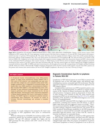 Chapter 82  Virus-Associated Lymphoma 1251
Diagnostic Considerations Specific to Lymphoma
in Patients With HIV
Lymphomas in HIV-infected patients are more likely to present with
B symptoms such as fever and night sweats, and advanced stage,
including bone marrow, extranodal, and CNS involvement. Thus the
approach to diagnosis is somewhat different than the approach in the
HIV-negative patient.
Unexplained fever and sweats in an HIV-seropositive patient, even
in the absence of lymphadenopathy, are sufficient to warrant consid-
eration of HL. Patterns of disease involvement also differ in HIV-
infected patients. Contiguous spread so characteristic of classic HL
in other settings is less common in HIV HL. Bone marrow–only
presentations of HL are not uncommon (Fig. 82-5, D to G), and the
possibility of HL should be in the differential diagnosis even in the
absence of lymphadenopathy.
Patients with HIV-associated NHL have higher rates of extranodal
involvement, including bone marrow and CNS disease, as well as
higher stage disease and more aggressive tumors on average.72
There-
fore it is recommended that all HIV-seropositive patients with aggres-
sive NHL undergo a diagnostic lumbar puncture. The routine use of
CNS intrathecal chemotherapy prophylaxis in all HIV-seropositive
NHL patients is controversial but reasonable and typically done in
particularly high-risk patients, such as those with BL, marrow or
testicular involvement, or extranodal disease.
Imaging is often more difficult to interpret in HIV patients than
in other settings. Lymphadenopathy associated with HIV infection
or opportunistic infection is common, and the presumption that
enlarged lymph nodes reflect the presence of lymphoma in patients
with known lymphoma or history of lymphoma is not as safe as in
tic infection. As a result, malignancy has emerged as the major cause
of mortality in HIV populations with access to antiretroviral
therapy.57,58
With the widespread use of HAART, the incidence of HL in HIV-
seropositive patients has not declined; patients with CD4+
counts
between 150 and 199 cells/mm3
actually have higher risk for
HIV-associated HL than patients with CD4+
counts of less than
50 cells/mm3
.59
HIV Hodgkin Lymphoma
A 42-year-old human immunodeficiency virus (HIV)–positive
patient, on highly active antiretroviral therapy (HAART) with a
CD4 count of 324 cells/mm3
and undetectable viral load, pres-
ents with fever, weight loss, and a palpable axillary lymph node.
Hodgkin lymphoma (HL) is diagnosed on excisional biopsy, and
Epstein-Barr virus (EBV) positivity is demonstrated by Epstein-
Barr–encoded RNA (EBER) in the Reed-Sternberg tumor cells.
Although he lacks additional lymphadenopathy, a bone marrow
biopsy is performed, and it shows involvement by HL. He has
stage IVB disease. Pneumocystis jiroveci pneumonia prophylaxis
is started despite adequate CD4 count in anticipation of chemo-
therapy. His HAART regimen is reviewed for potential antiviral-
chemotherapy drug interactions. He receives six cycles of
full-dose, first-line chemotherapy and achieves a complete
remission.
Figure 82-5  EXAMPLES OF HUMAN IMMUNODEFICIENCY VIRUS (HIV)–RELATED LYMPHOMAS. Primary central nervous system (CNS)
lymphoma in HIV+ patients (A to C). Gross appearance (coronal section) of the brain from an autopsy of a 24-year-old HIV+ female patient with temporo-
parietal mass due to a primary CNS lymphoma (A). The patient died from uncal and cingulate herniation. Biopsy section from another patient showing a
perivascular infiltrate of large lymphoma cells. This is the typical pattern of involvement by CNS lymphoma (B). The cells were shown to be CD20+
B cells
and were EBER+ (C). A diagnosis can be made without biopsy when magnetic resonance imaging studies show characteristic features and EBV is demonstrated
in the cerebrospinal fluid by polymerase chain reaction (see box on AIDS Primary Central Nervous System Lymphoma). Hodgkin lymphoma extensively
involving the bone marrow in an HIV+ patient with stage IVB disease (D to G). The bone marrow biopsy was entirely replaced with Hodgkin lymphoma
associated with dense sclerosis (D). An EBER study shows scattered positive cells throughout the marrow (E), corresponding to the Hodgkin and Reed-Sternberg
cells (F), which were CD30+
as illustrated (G). Hodgkin lymphoma infrequently involves the bone marrow in HIV-negative cases but some HIV+ patients can
first present with extensive bone marrow disease (see box on HIV Hodgkin Lymphoma). (A courtesy Dr. Peter Pytel, University of Chicago.)
A
B CC E G
D F
 