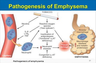 Pathogenesis of Emphysema
21
 