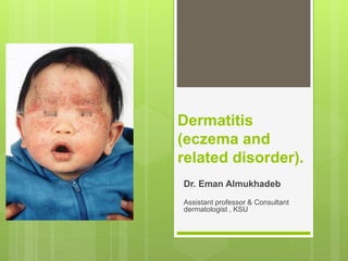 Dermatitis
(eczema and
related disorder).
Dr. Eman Almukhadeb
Assistant professor & Consultant
dermatologist , KSU
 