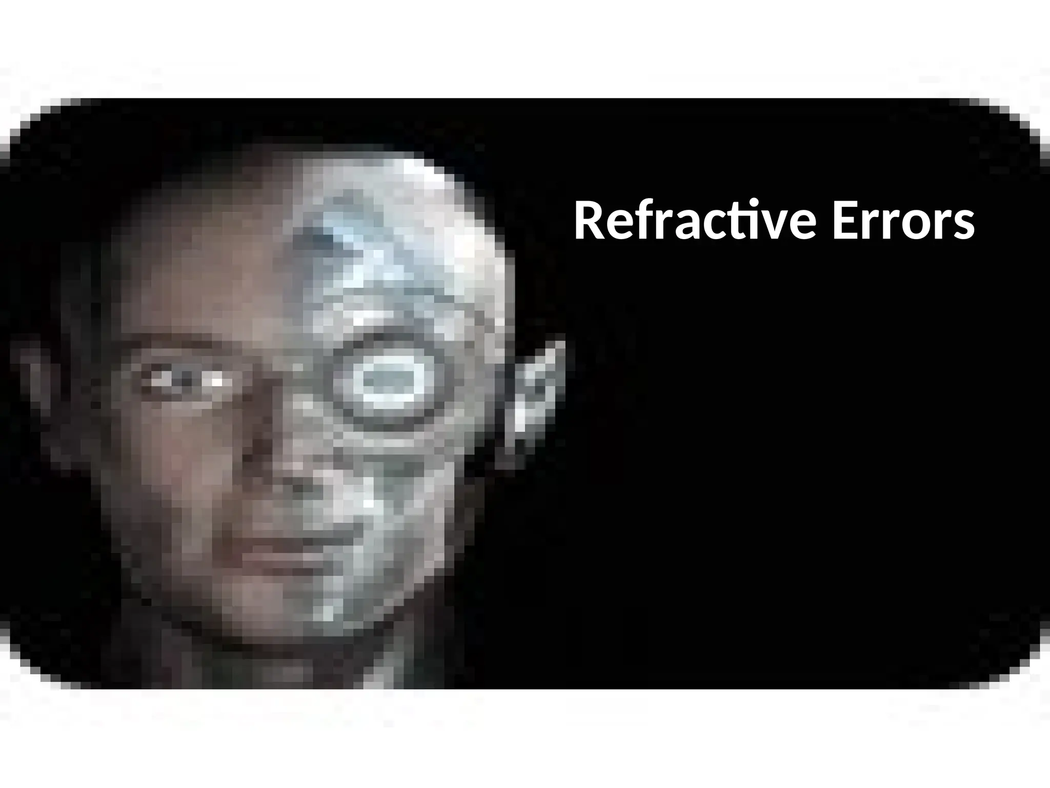 Refractive Errors
 