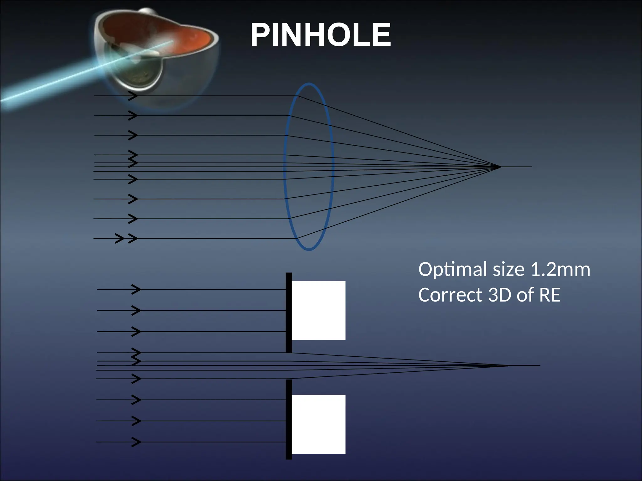 PINHOLE
Optimal size 1.2mm
Correct 3D of RE
 