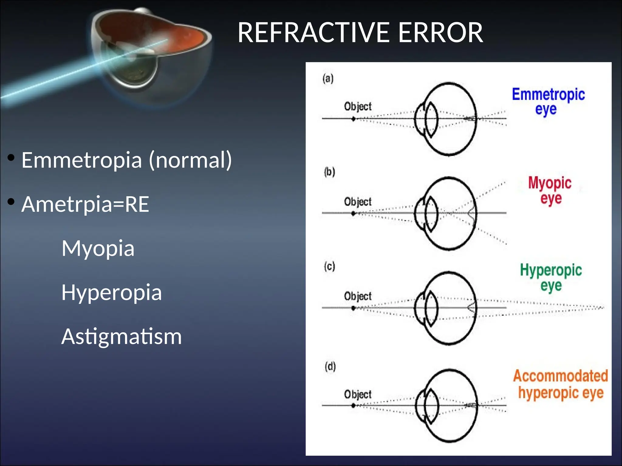REFRACTIVE ERROR
• Emmetropia (normal)
• Ametrpia=RE
Myopia
Hyperopia
Astigmatism
 