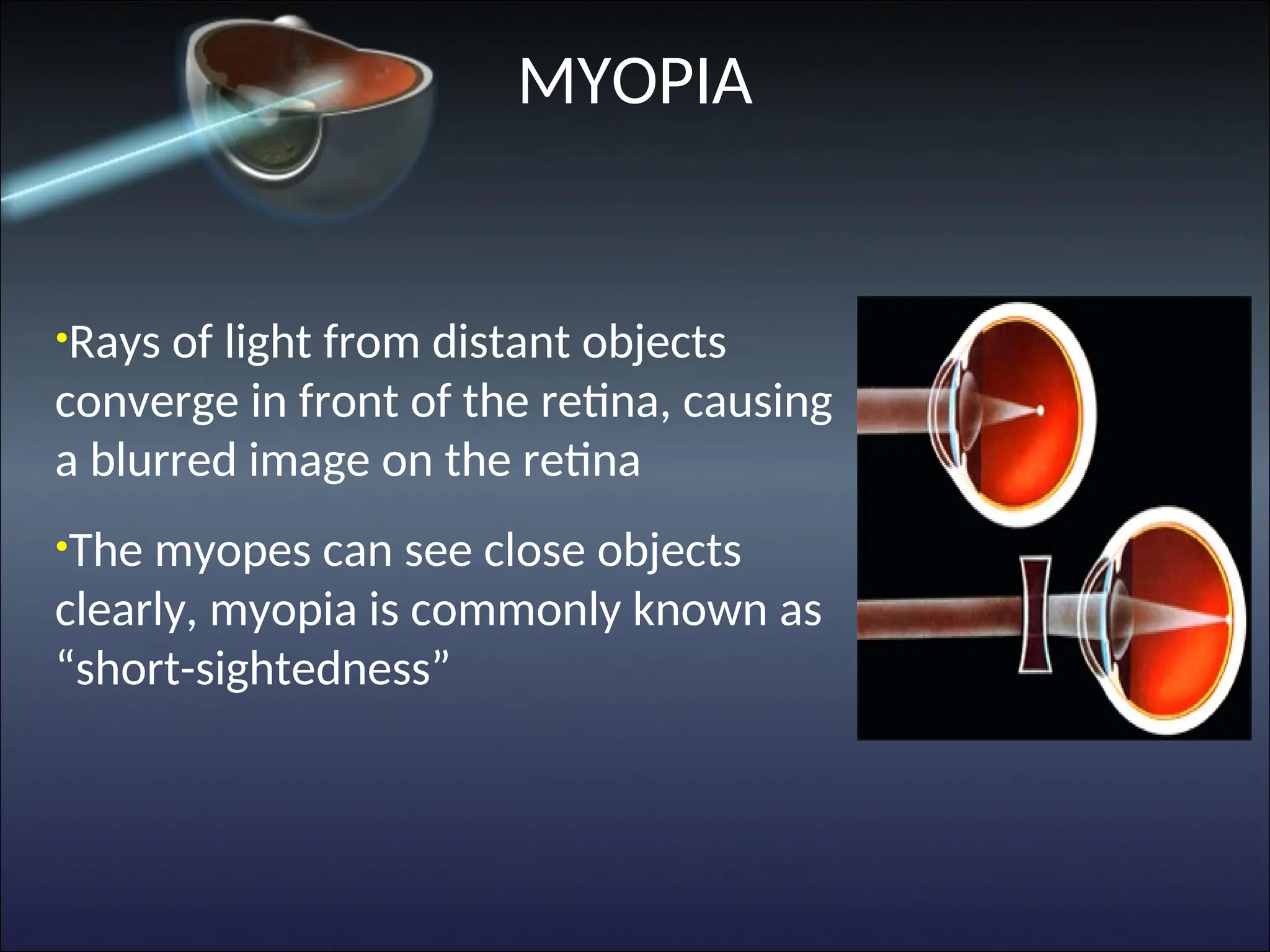 •Rays of light from distant objects
converge in front of the retina, causing
a blurred image on the retina
•The myopes can see close objects
clearly, myopia is commonly known as
“short-sightedness”
MYOPIA
 