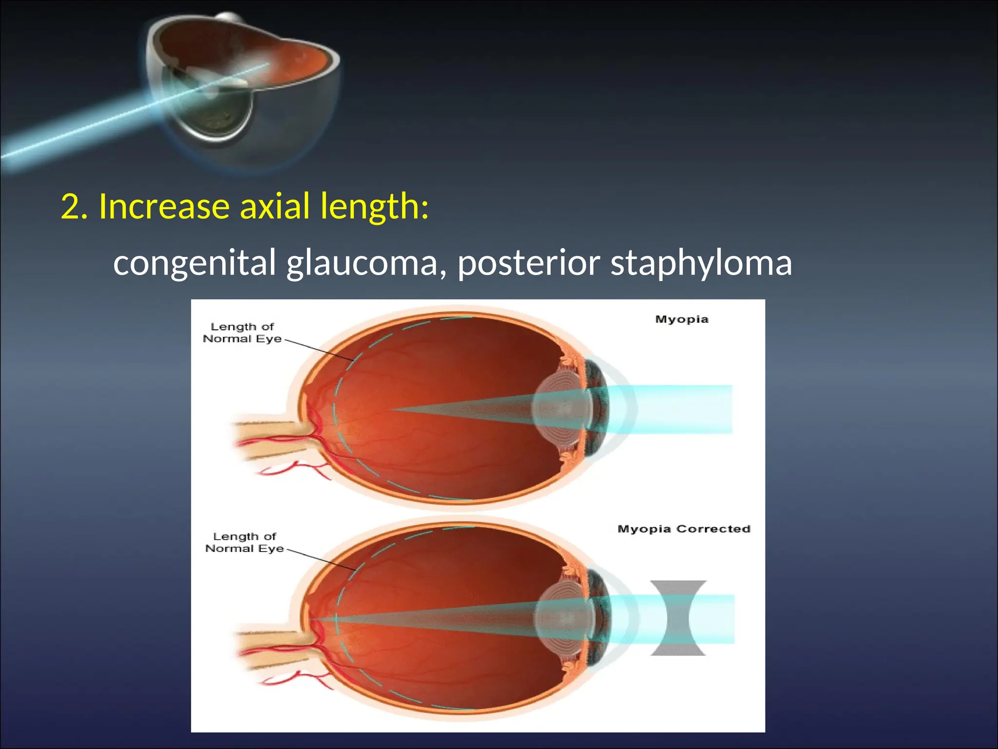 2. Increase axial length:
congenital glaucoma, posterior staphyloma
 