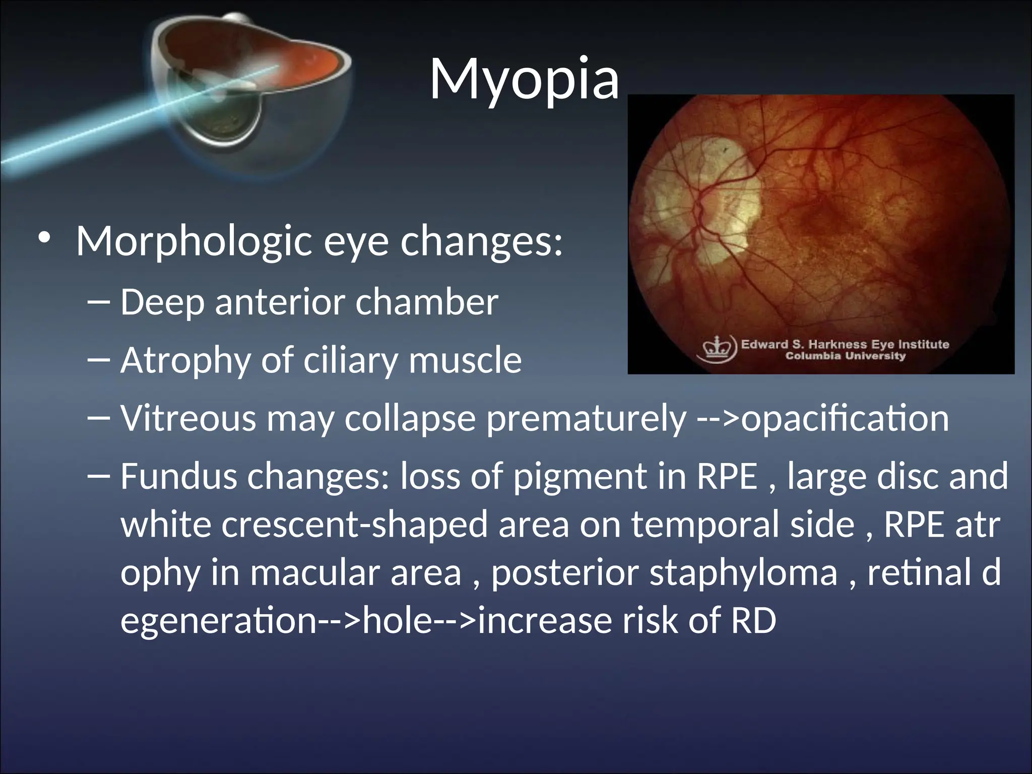 Myopia
• Morphologic eye changes:
– Deep anterior chamber
– Atrophy of ciliary muscle
– Vitreous may collapse prematurely -->opacification
– Fundus changes: loss of pigment in RPE , large disc and
white crescent-shaped area on temporal side , RPE atr
ophy in macular area , posterior staphyloma , retinal d
egeneration-->hole-->increase risk of RD
 