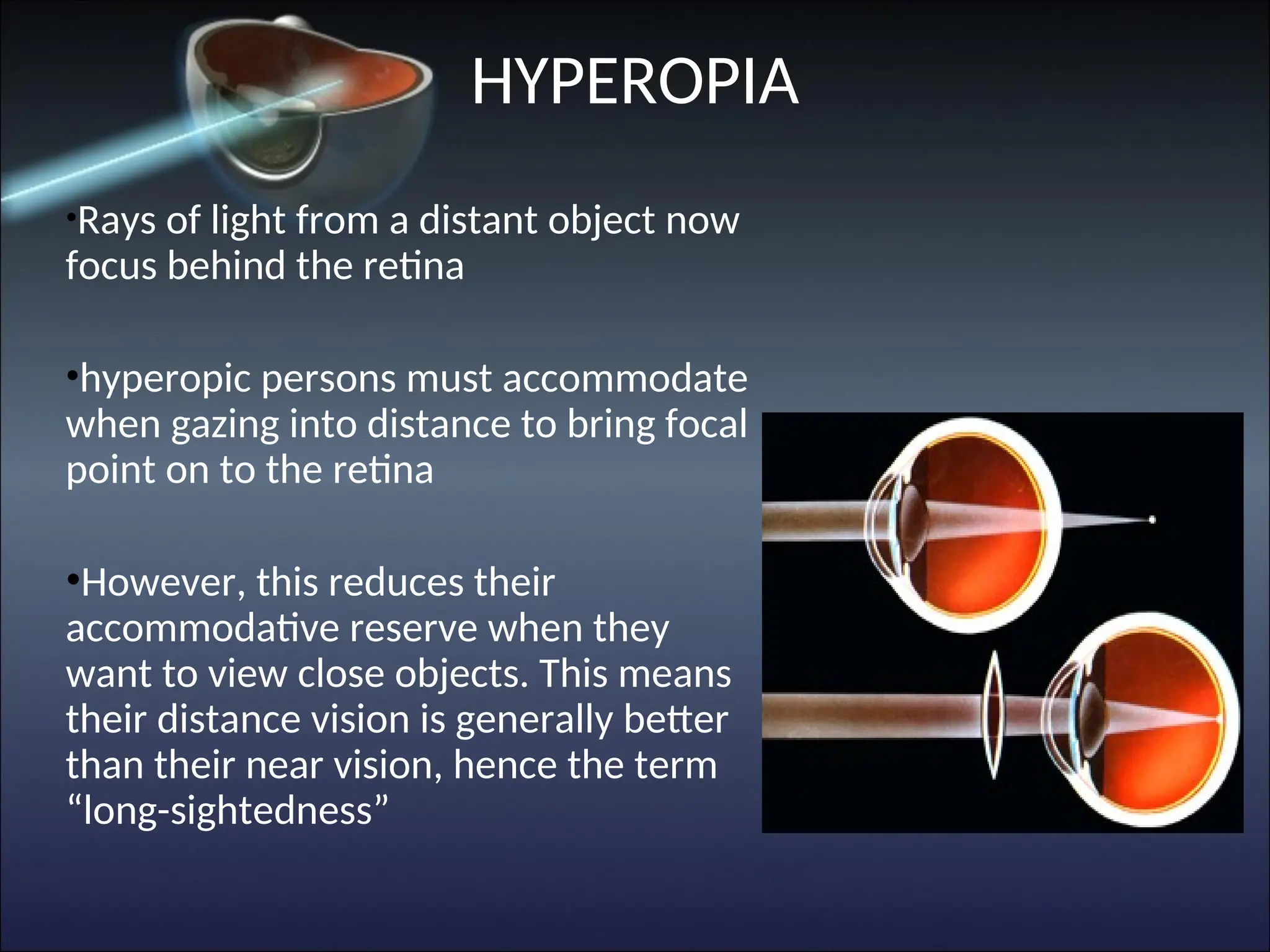 •Rays of light from a distant object now
focus behind the retina
•hyperopic persons must accommodate
when gazing into distance to bring focal
point on to the retina
•However, this reduces their
accommodative reserve when they
want to view close objects. This means
their distance vision is generally better
than their near vision, hence the term
“long-sightedness”
HYPEROPIA
 