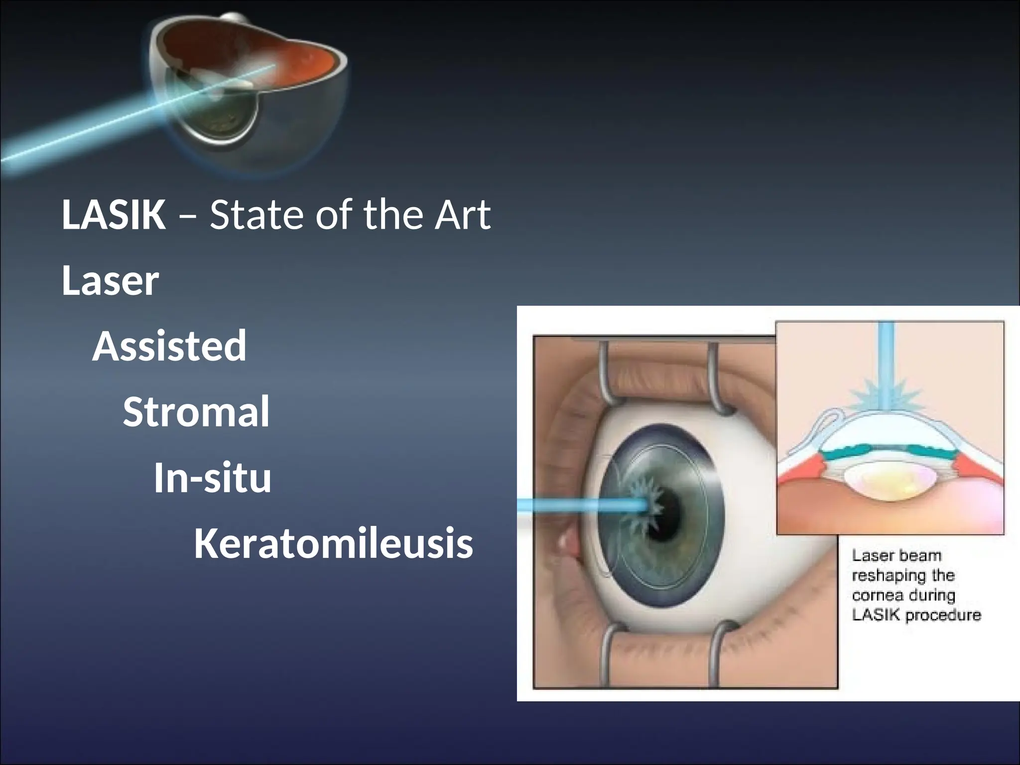 LASIK – State of the Art
Laser
Assisted
Stromal
In-situ
Keratomileusis
 