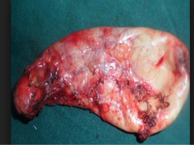gallbladder exam for L31 students cholecystitis gallbladder exam for L31 students cholecystitis