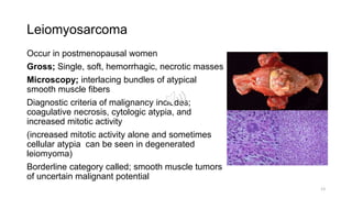 Leiomyosarcoma
Occur in postmenopausal women
Gross; Single, soft, hemorrhagic, necrotic masses
Microscopy; interlacing bundles of atypical
smooth muscle fibers
Diagnostic criteria of malignancy includes;
coagulative necrosis, cytologic atypia, and
increased mitotic activity
(increased mitotic activity alone and sometimes
cellular atypia can be seen in degenerated
leiomyoma)
Borderline category called; smooth muscle tumors
of uncertain malignant potential
13
 