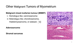 Other Malignant Tumors of Myometrium
Malignant mixed mullarian tumour (MMMT)
i- Homologus like; carcinosarcoma
ii- Heterologus like; chondrosarcoma,
rhabdomyosarcoma, or ostesarcoma
Adenosarcoma
Stromal sarcomas
14
 