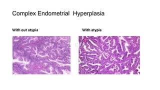 Complex Endometrial Hyperplasia
With out atypia With atypia
 