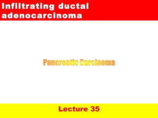 Lecture 35
Infiltrating ductal
adenocarcinoma
 