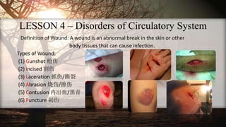 LESSON 4 – Disorders of Circulatory System
Definition of Wound: A wound is an abnormal break in the skin or other
body tissues that can cause infection.
Types of Wound:
(1) Gunshot 枪伤
(2) Incised 割伤
(3) Laceration 抓伤/撕裂
(4) Abrasion 烧伤/擦伤
(5) Contusion 内出血/黑青
(6) Puncture 刺伤
 